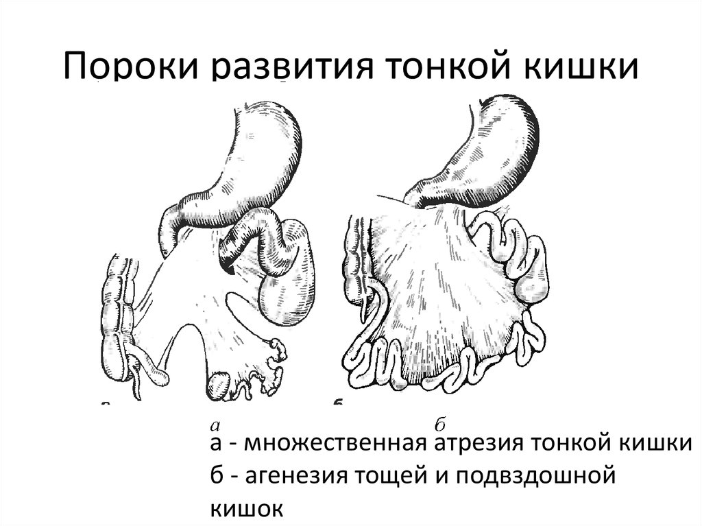 Аномалии развития. Пороки развития, атрезии тонкой кишки. Пороки развития двенадцатиперстной кишки. Аномалии развития тонкого кишечника. Атрезия тонкой кишки у детей.