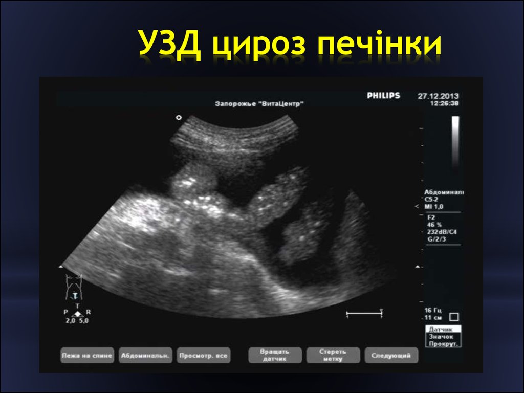 Гепатит желчный пузырь. Ультразвуковое исследование при патологии печени. Снимок УЗИ печени здоровой.