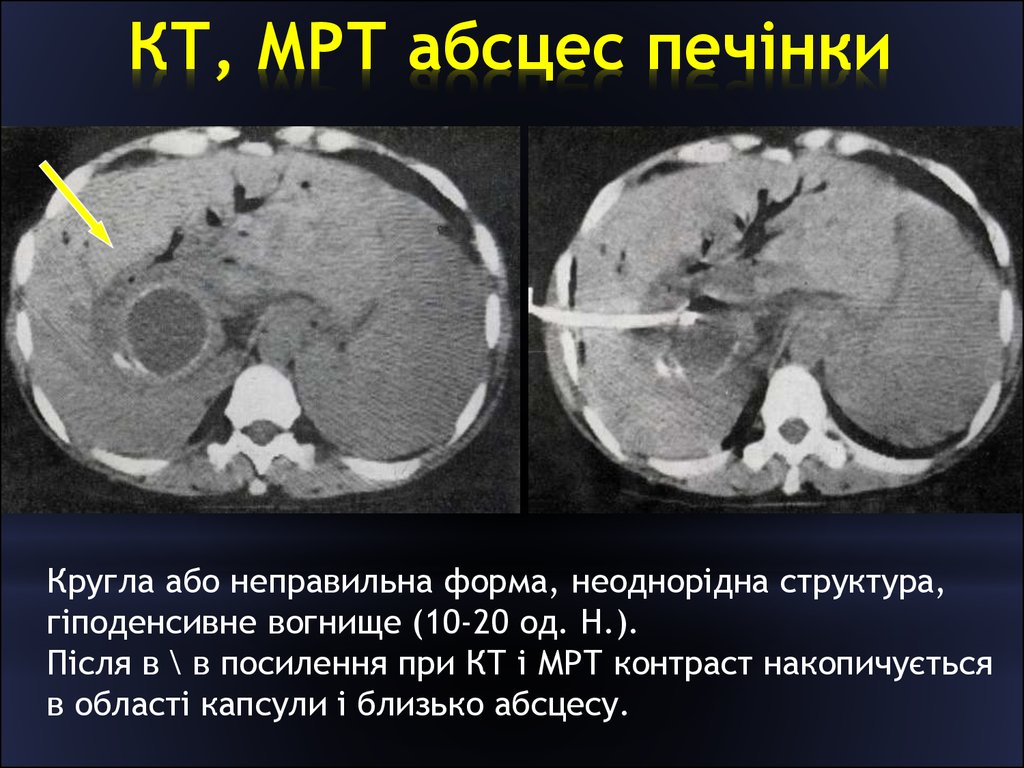 Кт печени. Холангиогенный абсцесс печени кт. Амебный абсцесс печени кт. Пиогенный абсцесс печени кт.