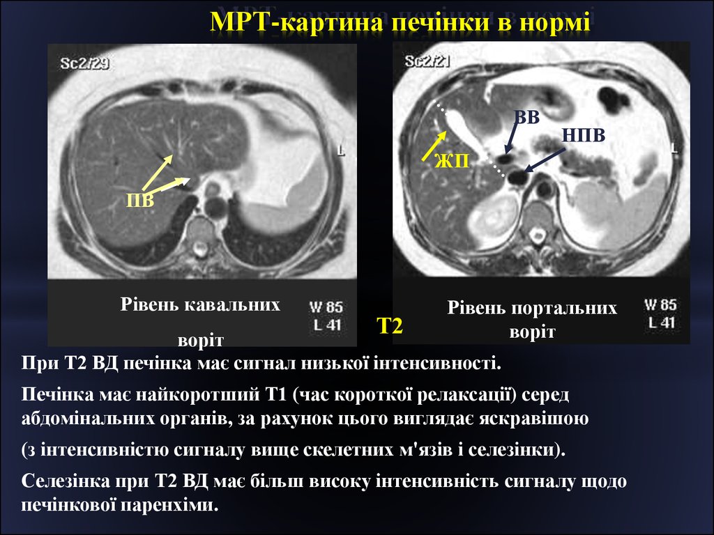 МРТ-картина печінки в нормі
