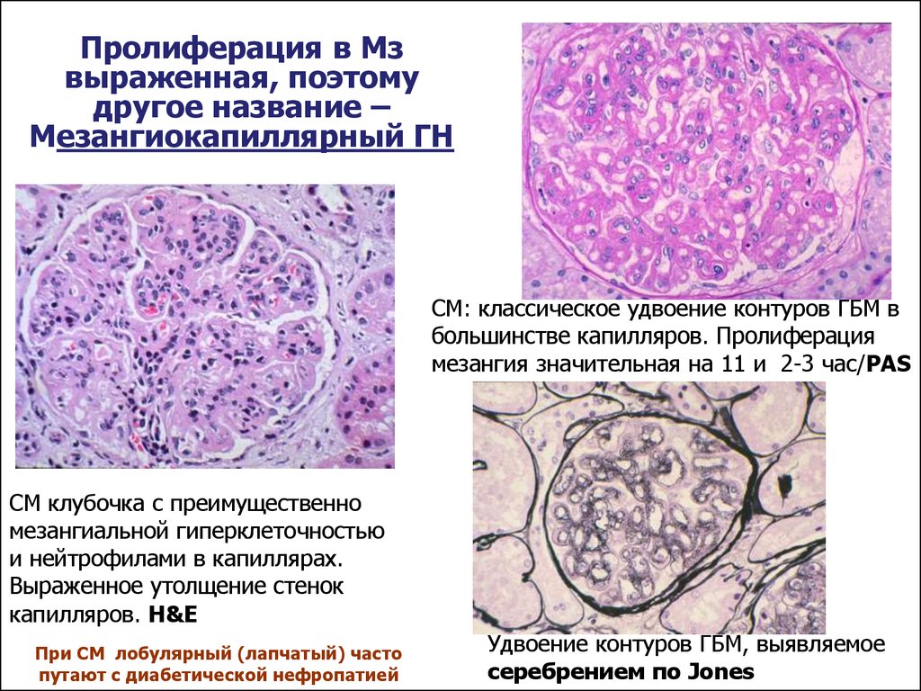 Пролиферация клеток. Мезангиокапиллярный гломерулонефрит. Мезангиокапиллярный гломерулонефрит гистология. Мезангиокапиллярный гломерулонефрит микропрепарат. Пролиферация мезангия.