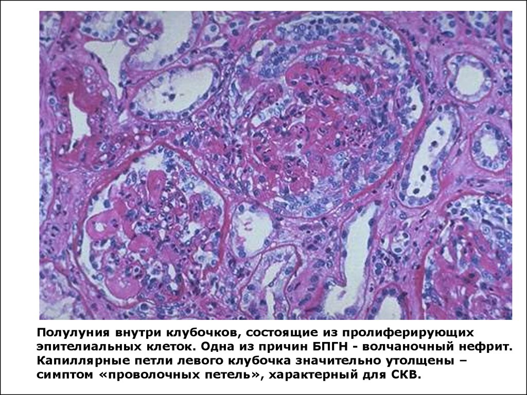 Хронический пиелонефрит микроскопическая картина