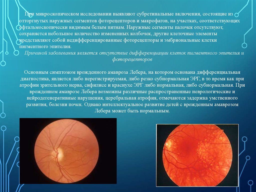 Атрофия сетчатки глаза лечение. Заболевания сетчатки и зрительного нерва.