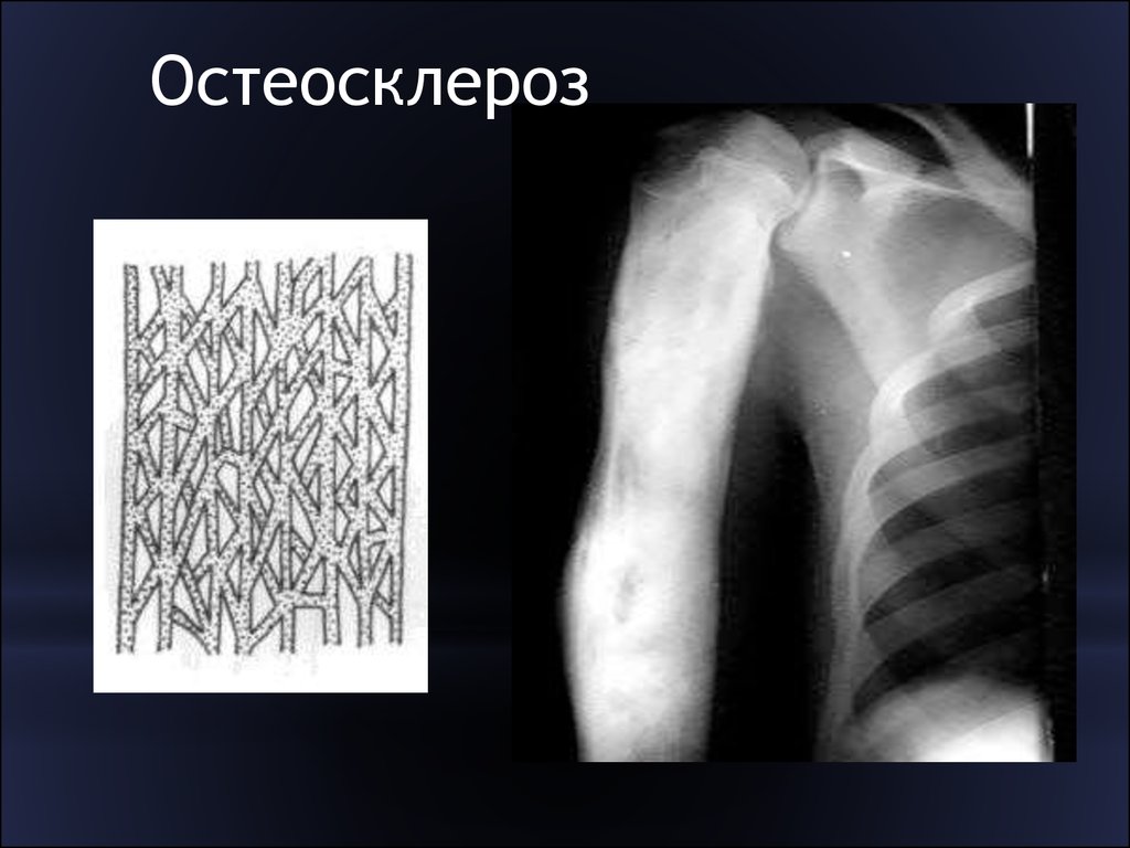 Остеосклеротические очаги в костях