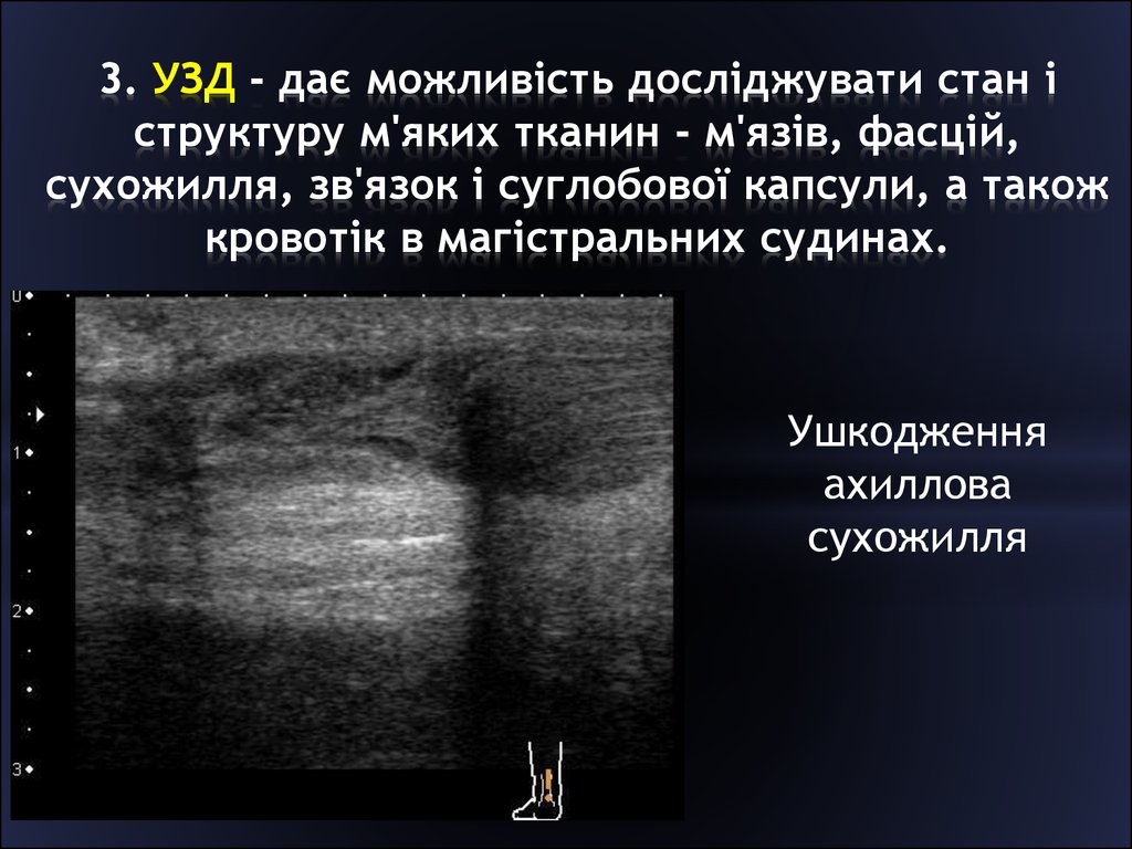 Образование мягких тканей. УЗИ мягких тканей бедра протокол. УЗИ мягких тканей голени.