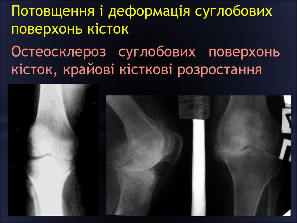 Полное расхождение суставных концов костей. Локальный остеосклероз кости кт. Остеосклероз берцовой кости. Остеосклероз плечевой кости. Остеосклероз головки бедренной кости.