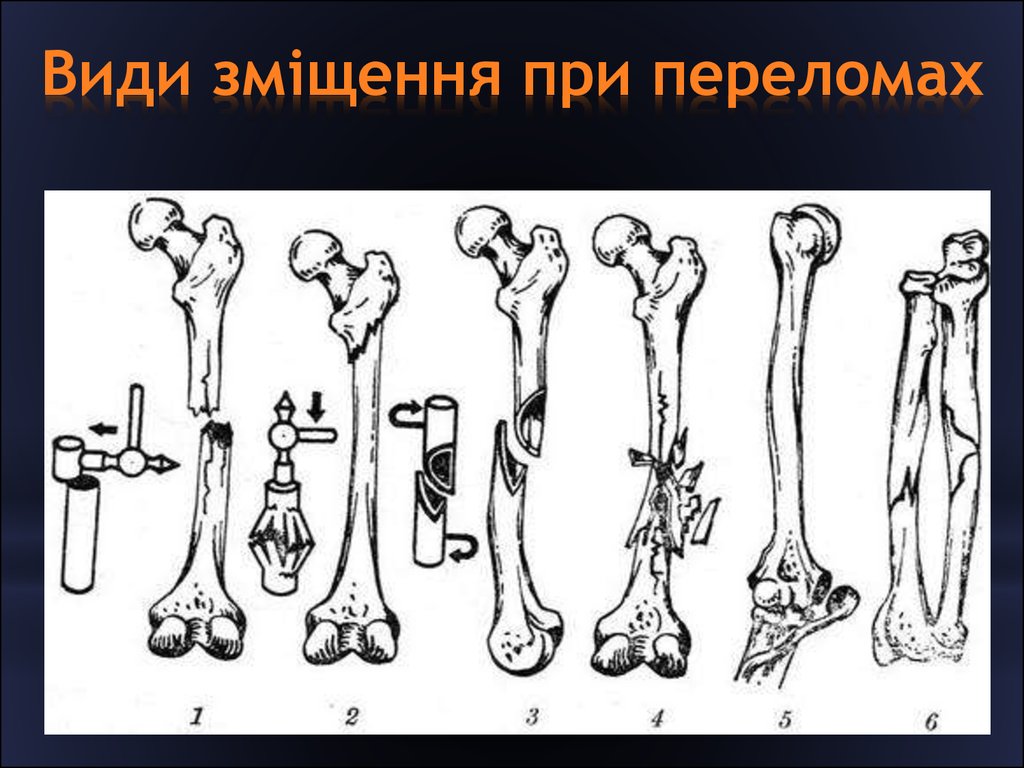 1 тип перелома. Перелом со смещением костных отломков. Классификация смещений костных отломков. Типы смещения трубчатых костей. Смещение отломков костей.