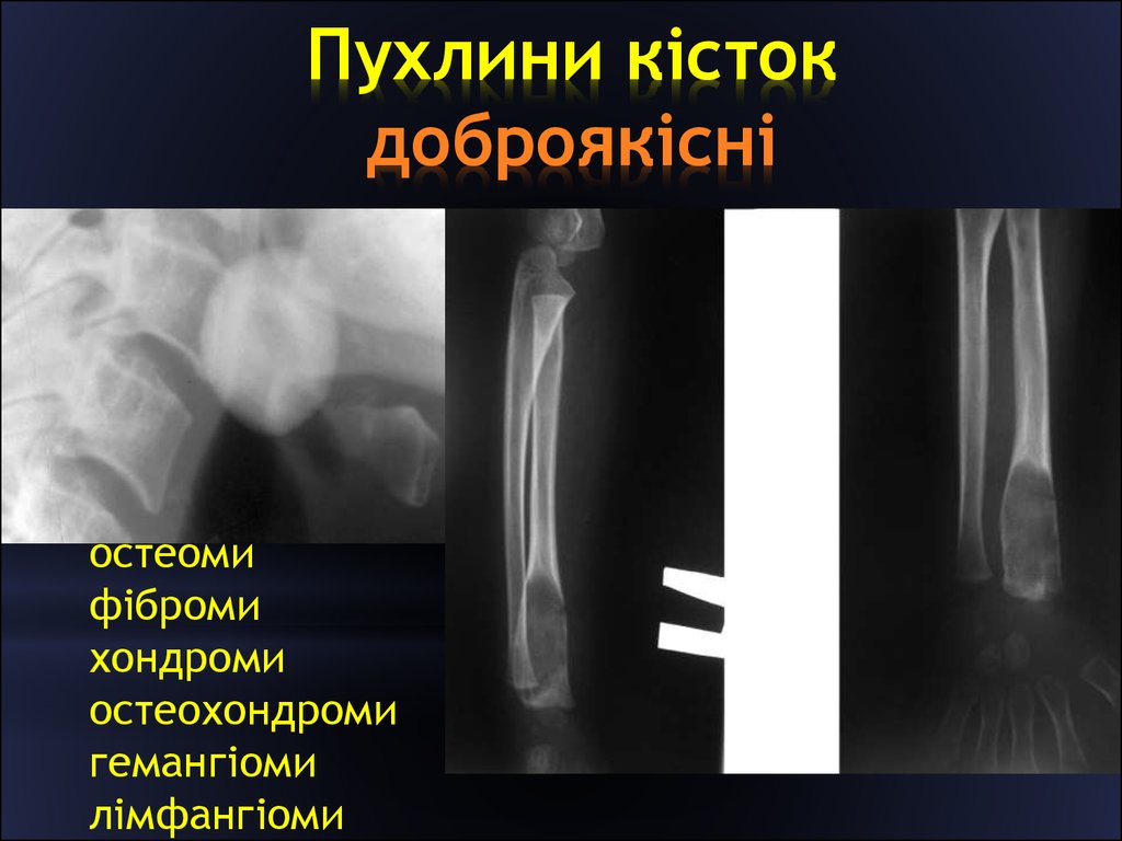 Лечение опухолей костей. Остеома доброкачественная рентген. Остеоид-остеома бедренной кости. Доброкачественная опухоль кости рентген. Остеома бедренной кости рентген.