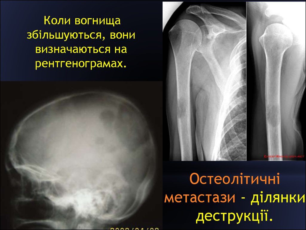 Метастатическое поражение кости. Остеолитическая деструкция кости что это. Остеобластические метастазы в длинной трубчатой кости. Остеобластические метастазы рентген. Остеолитическое поражение костей.