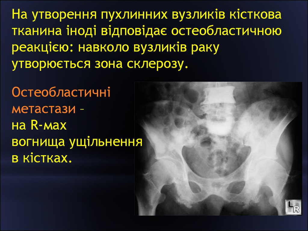 Метастатическое поражение костей. Остеобластические метастазы в кости. Остеобластические очаги. Метастазы в кости рентгенодиагностика. Остеолитические и остеобластические метастазы.