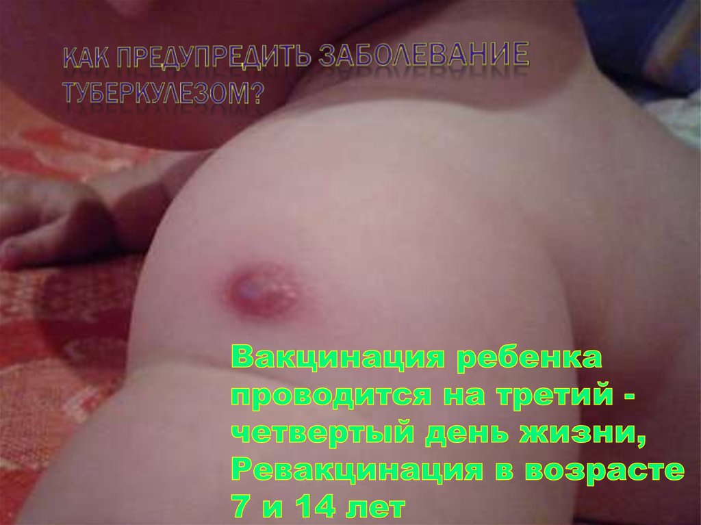 Как предупредить заболевание туберкулезом?