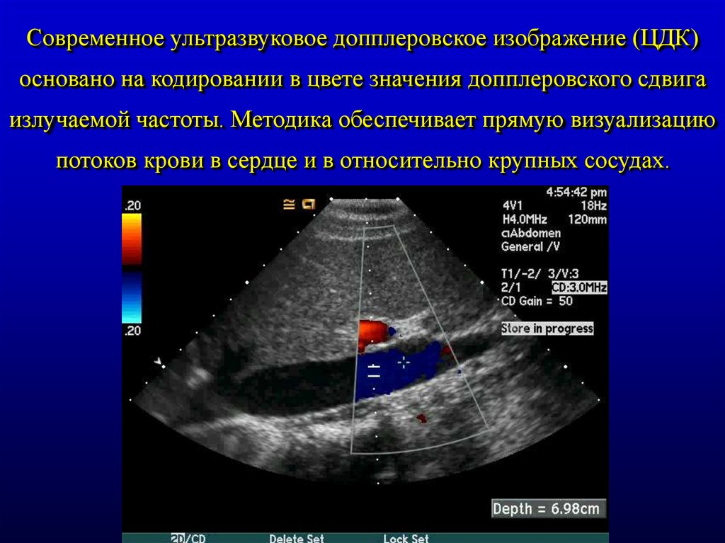 Что значит узи с цдк. Цветное допплеровское картирование (ЦДК). Ультразвуковая диагностика презентация. Цветовое допплеровское картирование ЦДК.