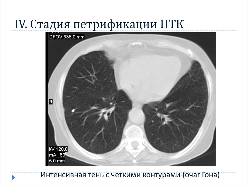 Очаги в легких с четкими контурами