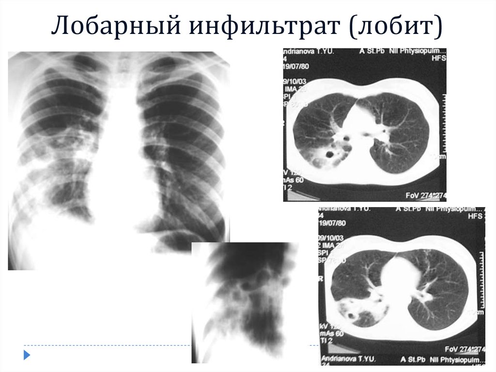 Врожденная лобарная эмфизема клиника рентгенологическая картина принципы лечения