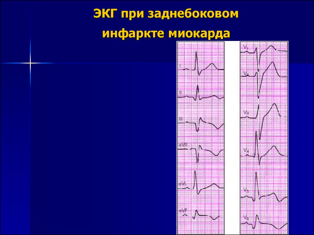 Инфаркт на экг. Острый инфаркт миокарда верхушечный ЭКГ. Острый инфаркт миокарда задней стенки на ЭКГ. Боковой острый инфаркт миокарда на ЭКГ. Инфаркт миокарда заднебоковой стенки на ЭКГ.