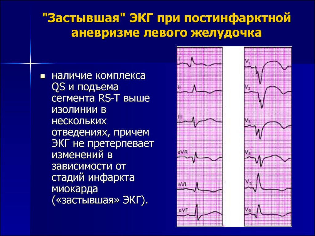 Изменение миокарда перегородочной области. ЭКГ признаки аневризмы сердца. Инфаркт миокарда с аневризмой ЭКГ. Постинфарктная аневризма левого желудочка на ЭКГ. Аневризма левого желудочка на ЭКГ.