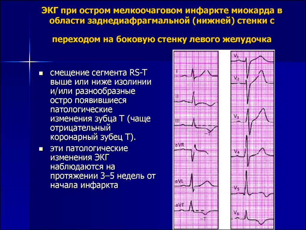 Очаговые изменения на экг. Инфаркт миокарда передней стенки ЭКГ. Мелкоочаговый и крупноочаговый инфаркт на ЭКГ. Острый Нижний (заднедиафрагмальный) инфаркт миокарда ЭКГ. Основной ЭКГ признак мелкоочагового инфаркта миокарда.