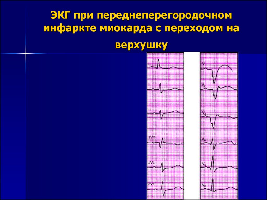 Перегородочный инфаркт экг. Переднеперегородочный инфаркт миокарда на ЭКГ. ЭКГ при переднеперегородочном инфаркте миокарда. Острый передне перегородочный инфаркт ЭКГ. Q инфаркт миокарда переднеперегородочный ЭКГ.