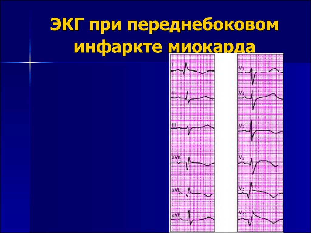 Кардиограмма при инфаркте миокарда фото сравнение с нормальной