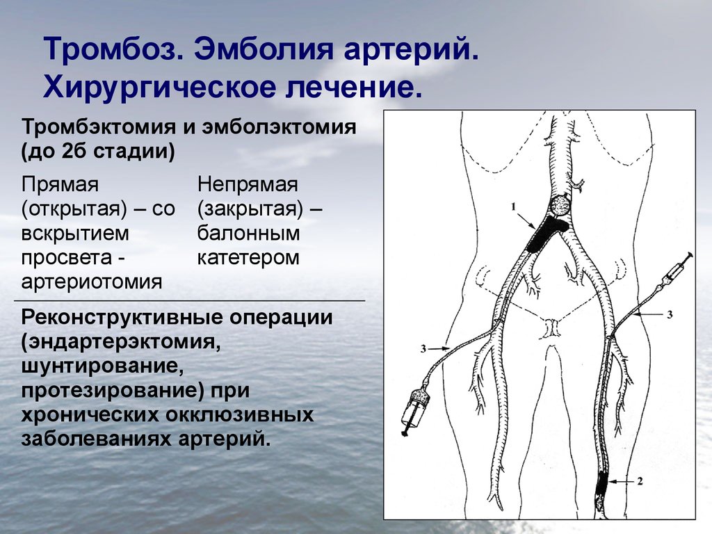 Артерия ноги операция. Тромбоэмболия магистральных артерий нижних конечностей. Тромбоэмболия бедренной артерии. Острой тромбоэмболии сосудов конечностей. Тромбэктомия бедренной артерии.