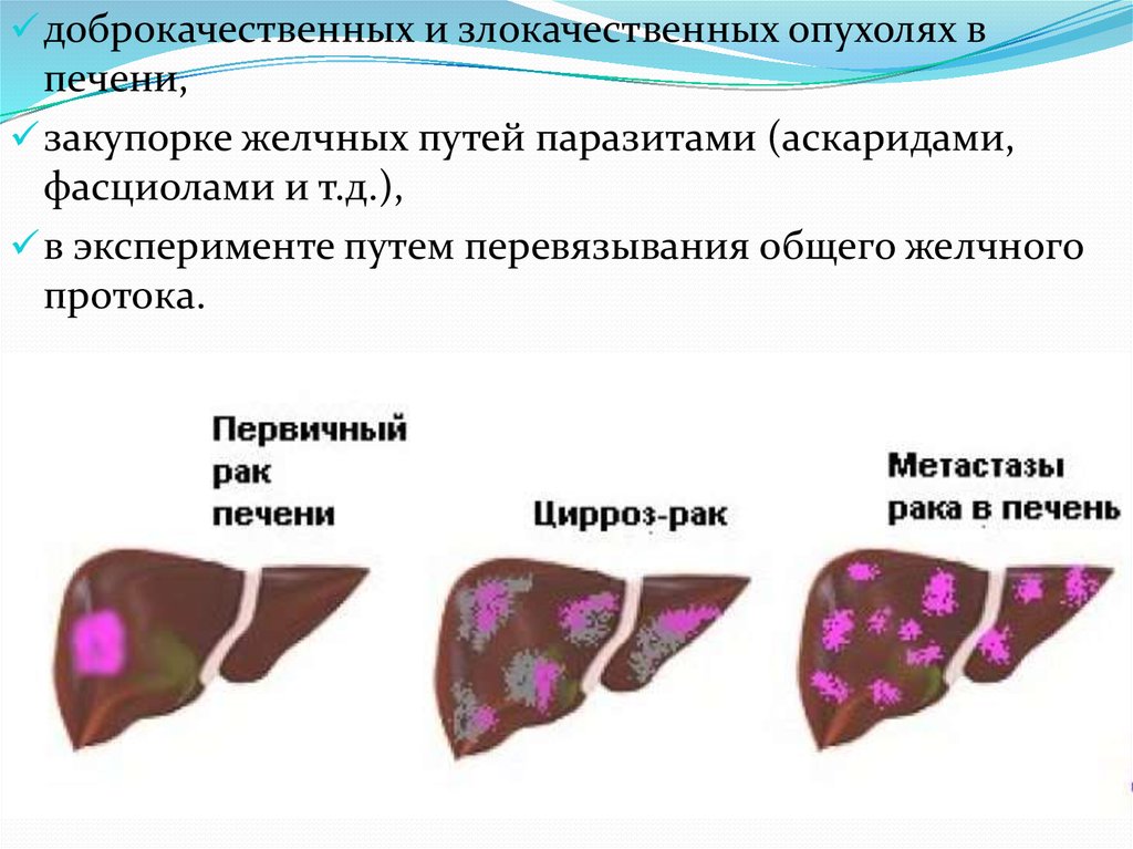 Округлое образование печени