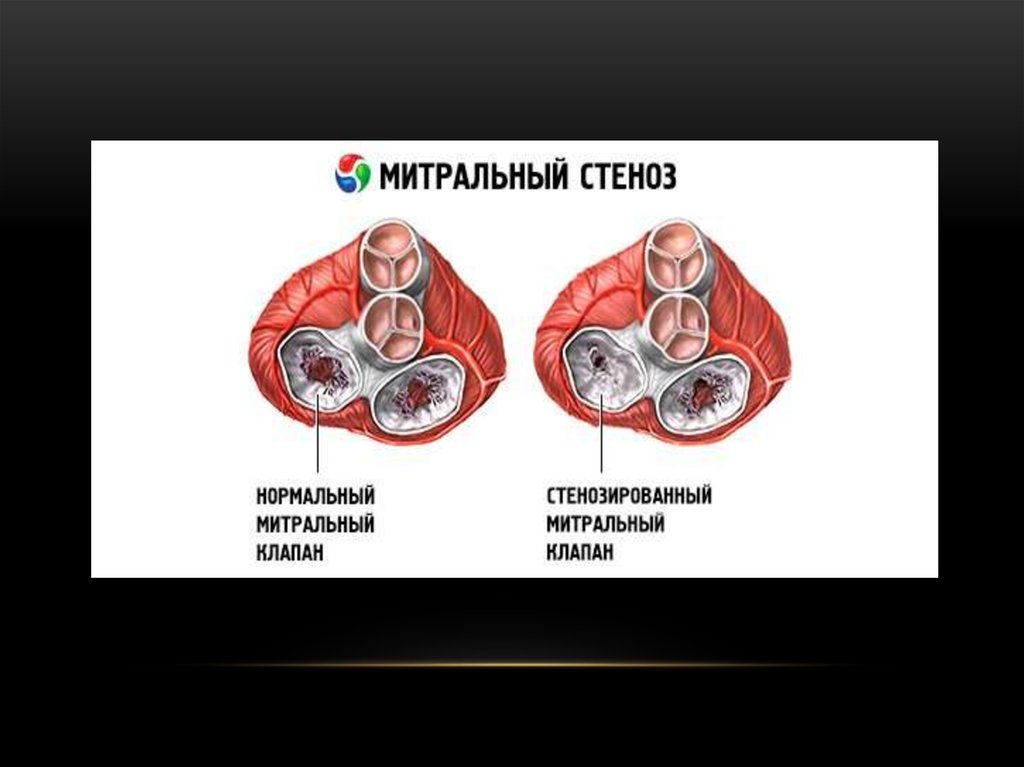 Митральный стеноз картинка