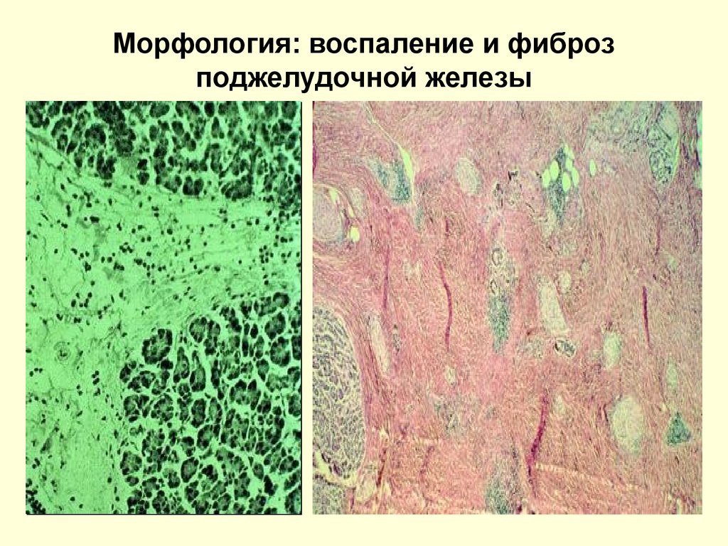 Фиброз железы. Соединительная ткань поджелудочной железы. Фиброз поджелудочной железы. Хронический панкреатит микропрепарат. Муковисцидоз микропрепарат.