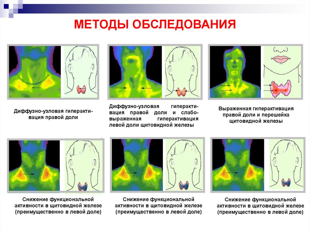 Щитовидная железа патофизиология презентация