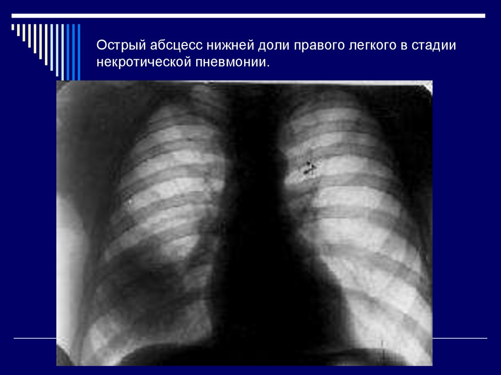 Острая инфекция легких. Абсцесс легкого пневмония рентген. Дренированный абсцесс легкого. Пневмония нижней доли правого легкого рентген. Стадии острого абсцесса легкого.