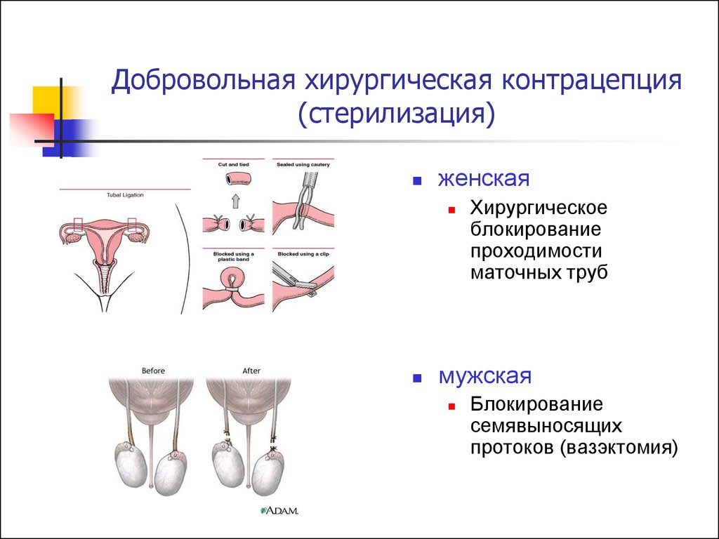 Сколько труб у женщины. Хирургические методы контрацепции. Мужская стерилизация. Добровольная хирургическая стерилизация методы контрацепции. Добровольная хирургическая стерилизация методики. Хирургические контрацепции (стерилизация) виды.
