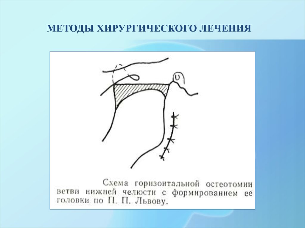 Презентация на тему анкилоз внчс