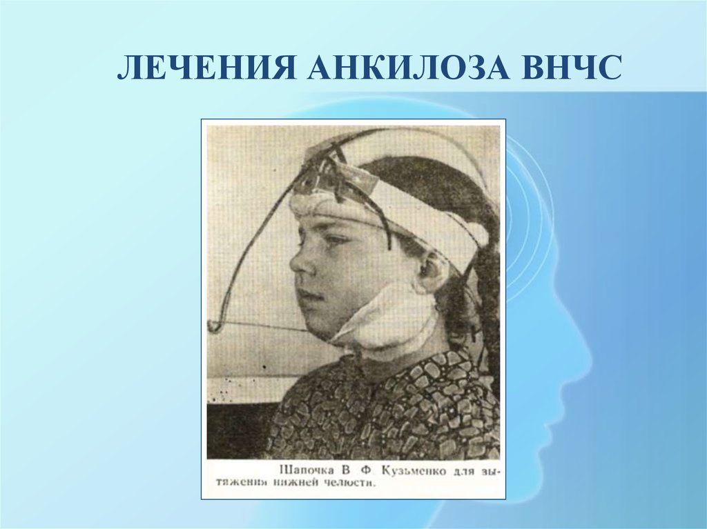 Анкилоз челюсти. Анкилоз нижней челюсти операции. Хирургические методы лечения анкилозов ВНЧС. Анкилоз ВНЧС классификация.