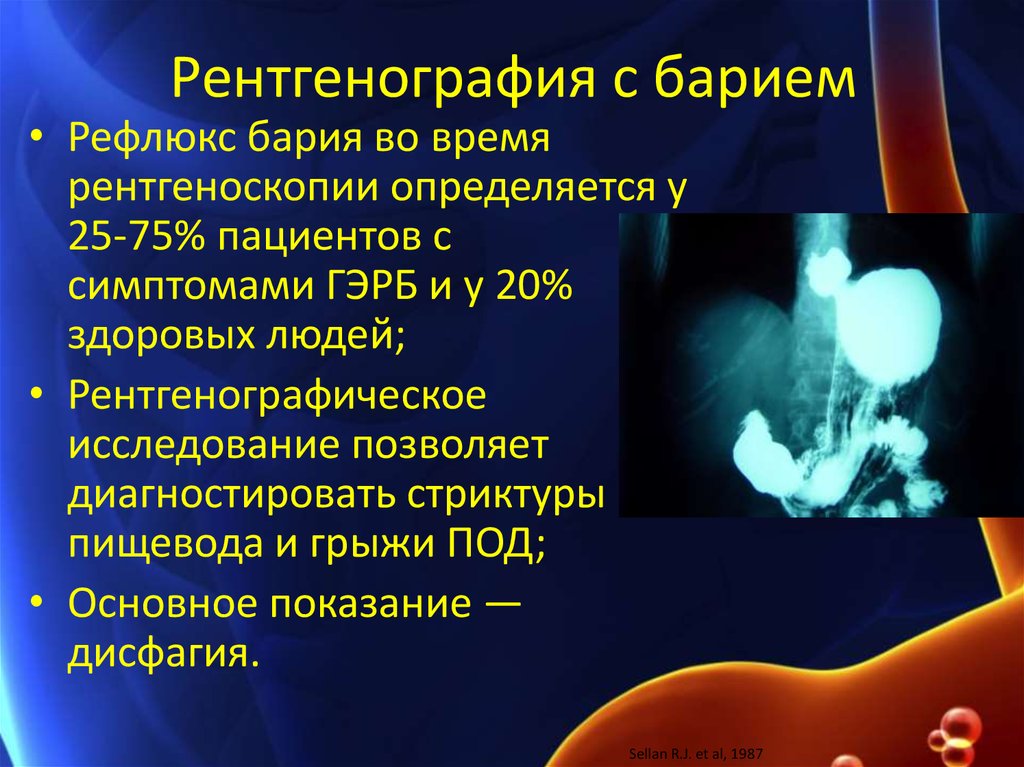Рентгеноскопия пищевода подготовка. Рефлюкс гастрит рентген. Рефлюкс желудка рентген. Рентгенографическое исследование желудка с барием.
