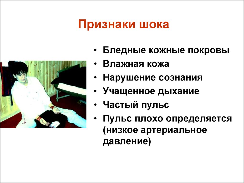 Признаки кожных покровов. Клинические проявления травматического шока. Симптомы характерные для шока. Признаки шокового состояния. Признаки шока у человека.