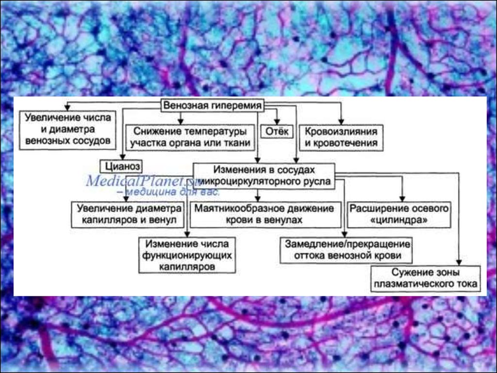 Венозная гиперемия. Венозная гиперемия стаз. Схема изменений микроциркуляции при венозной гиперемии. Механизм отека при венозной гиперемии. Механизм развития венозной гиперемии тканей.