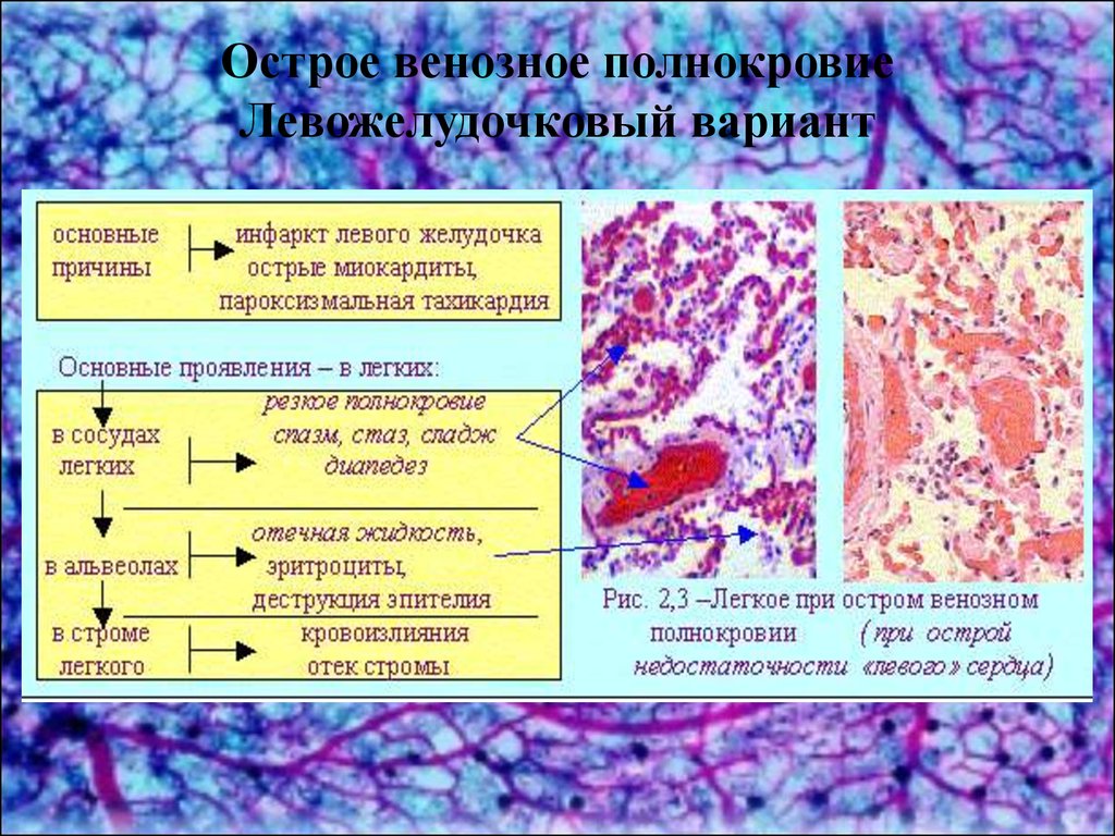 Венозный застой в печени. Исход острого общего венозного полнокровия. Лёгкое при остром венозном полнокровии. Венозное полнокровие и отек легких. Острое общее венозное полнокровие.