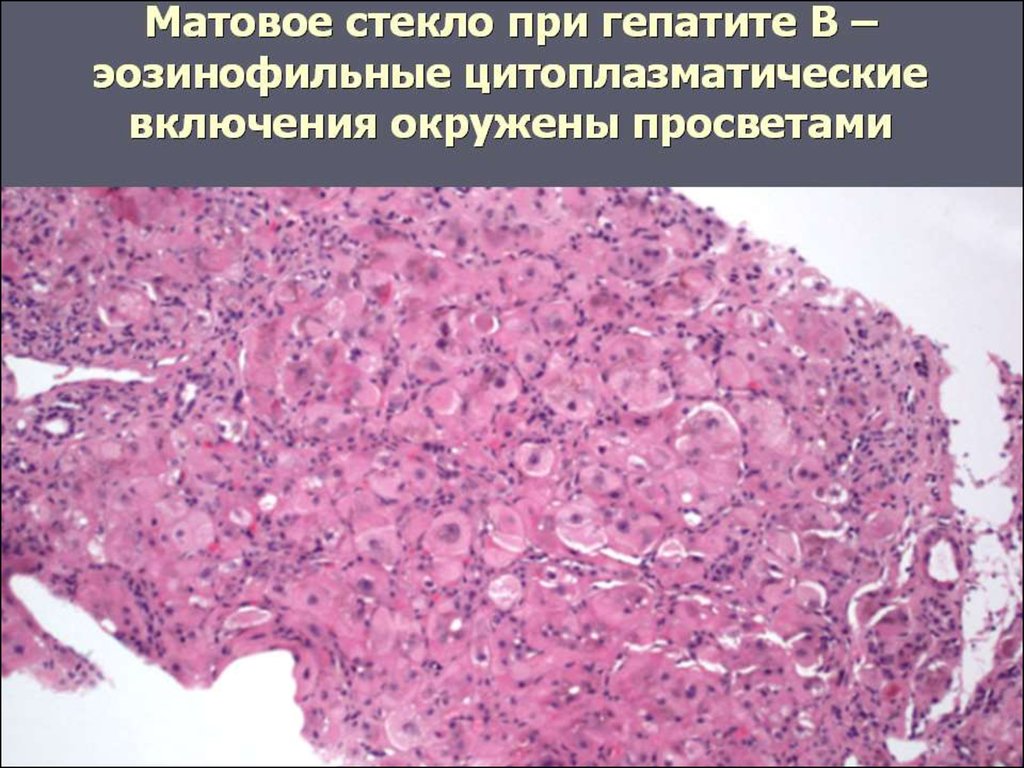 Хронические гепатиты невирусной этиологии клиническая картина