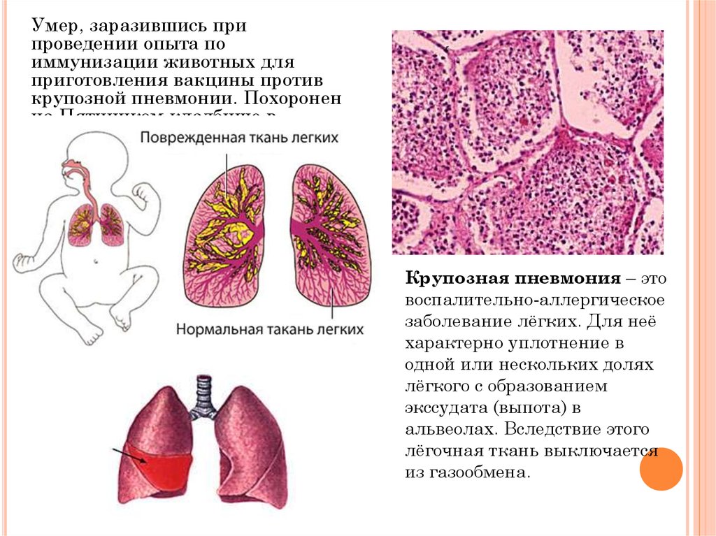 Поражение легочных тканей. Крупозная пневмония и бронхопневмония. Крупозная пневмония объем поражения. Крупозная пневмония локализация. Крупозная и очаговая пневмония.