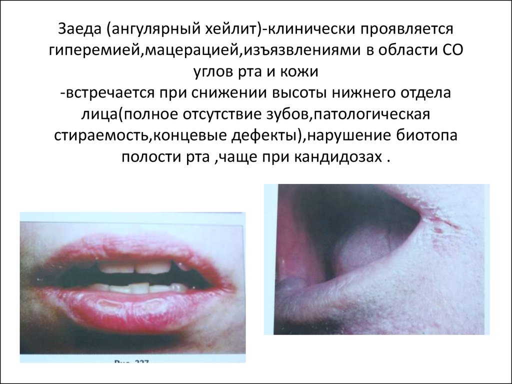 Заеда (ангулярный хейлит)-клинически проявляется гиперемией,мацерацией,изъязвлениями в области СО углов рта и кожи -встречается при сниже