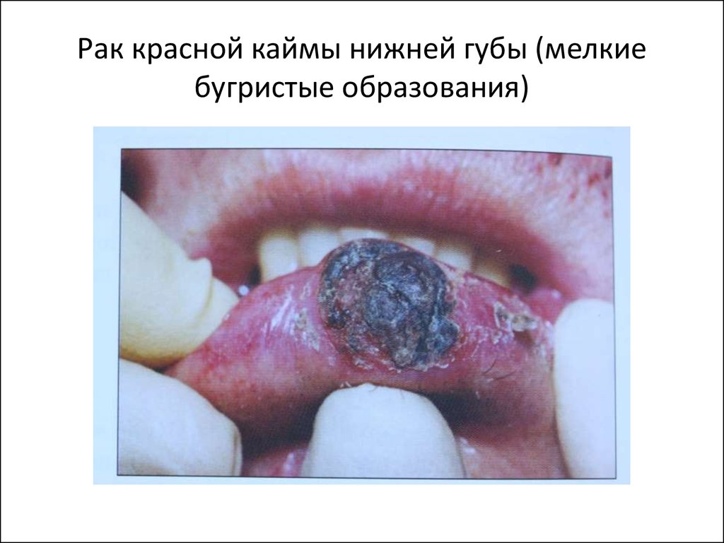 Рак красной каймы нижней губы (мелкие бугристые образования)