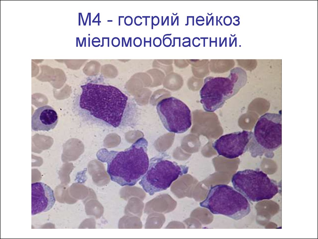 Волосатоклеточный лейкоз картина крови