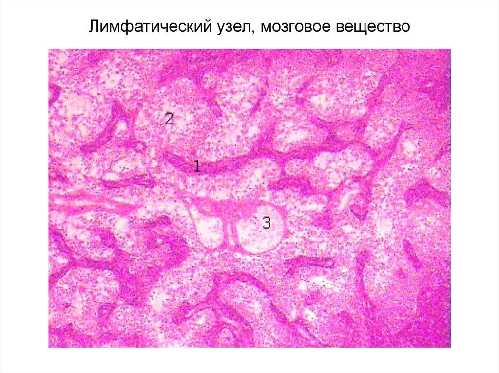 Узелки клеток. Лимфатический узел мозговое вещество гистология препарат. Лимфа препарат гистология. Лимфатический сосуд гистология препарат. Лимфоидные узелки гистология.