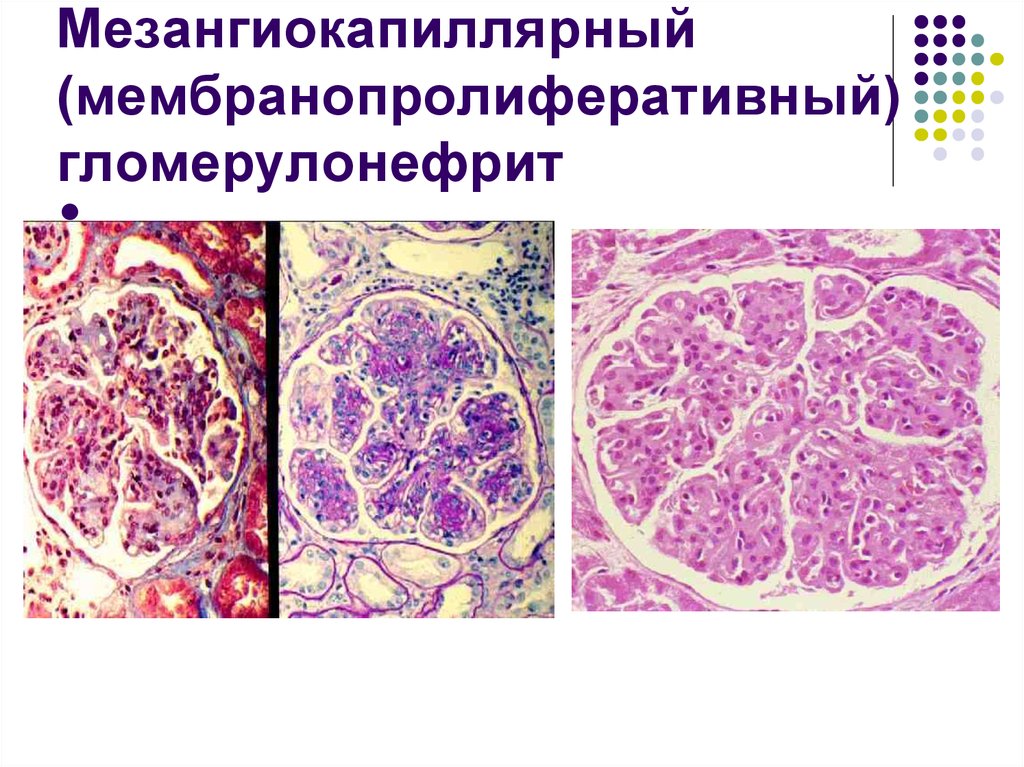 Морфологическая картина гломерулонефрита