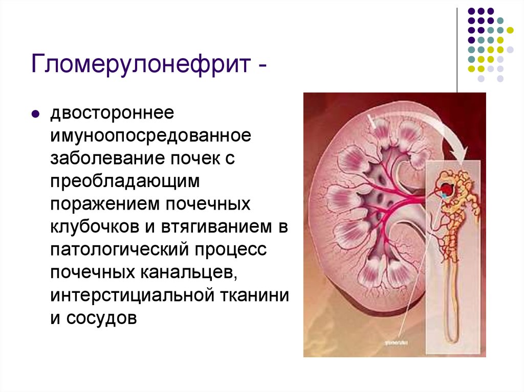 Гломерулонефрит картинки для презентации