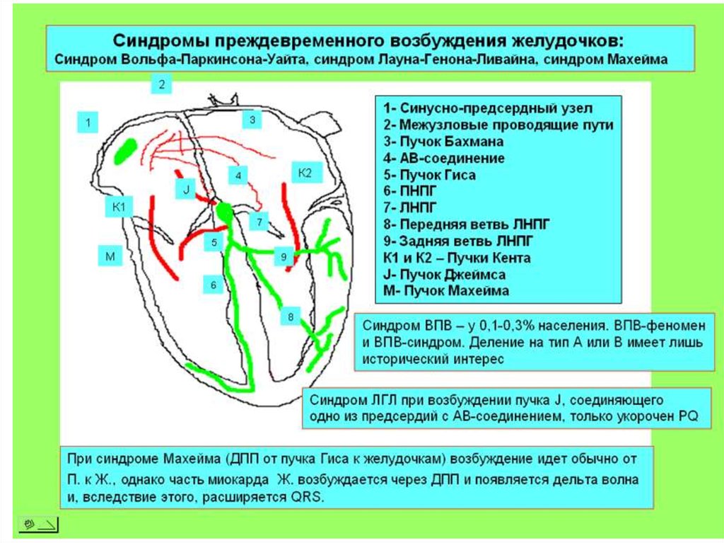 Дополнительный путь. Синдром предвозбуждения желудочков. Синдром преждевременного возбуждения желудочков на ЭКГ. Дополнительные пути проведения на ЭКГ. Дополнительные пути проведения.