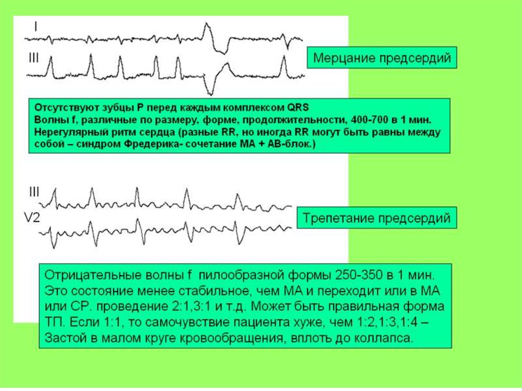 Ритм предсердий. ЭКГ Мерцательная аритмия мерцание желудочков. ЭКГ при блокаде и фибрилляции предсердий. ЭКГ аритмии и блокады. ЭКГ фибрилляция предсердий и блокада.
