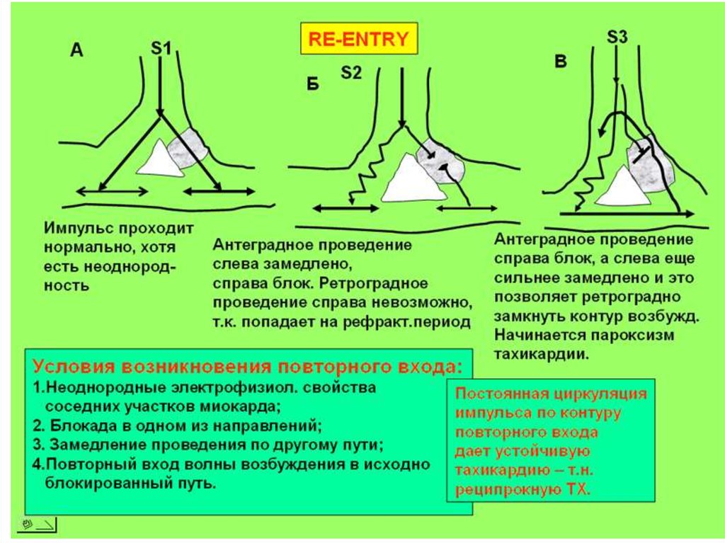 Волна возбуждения. Механизм повторного входа возбуждения. Повторный вход волны возбуждения. Ретроградное проведение импульса. Формирование повторного входа волны возбуждения (re-entry)..