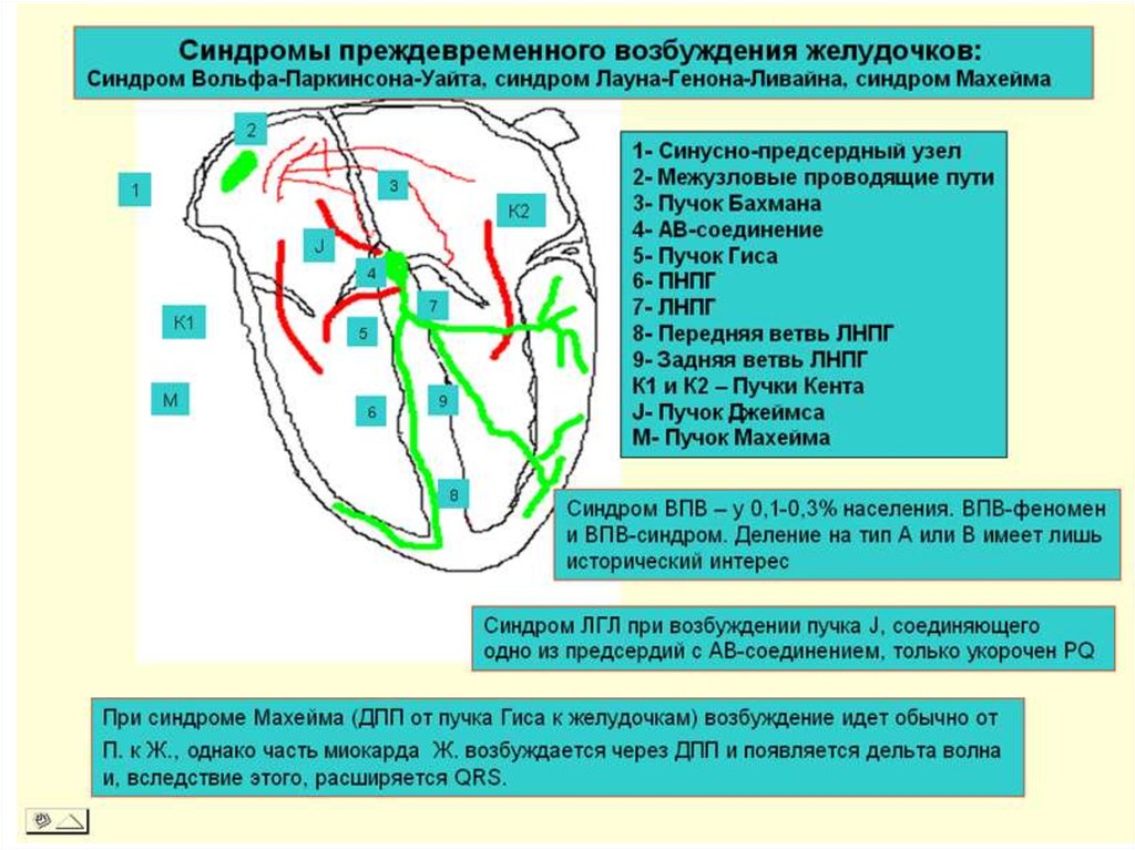 Возбуждение желудочков в основании сердца. Синдром преждевременного возбуждения желудочков. Пучок Махейма. Пучок Махейма в сердце. Синдром Махейма ЭКГ.