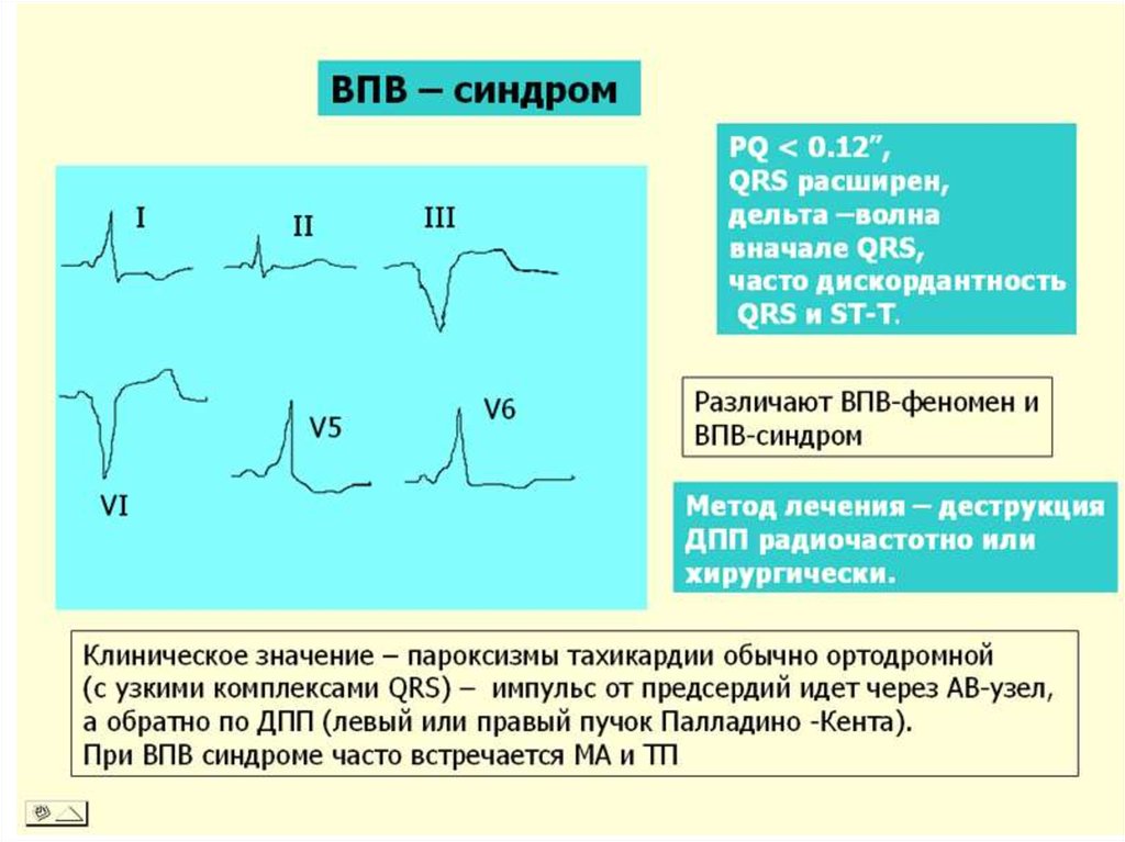 Wpw на экг фото