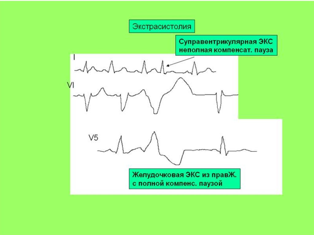Блокада экстрасистолы. Желудочковая экстрасистолия заключение ЭКГ. Ритм при желудочковой экстрасистолии на ЭКГ. Желудочковая экстрасистолия с блокадой. Av блокады и экстрасистолы на ЭКГ.